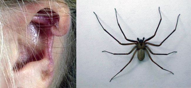 recluse-spider-bite