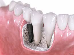 Импланты в современном стоматологическом протезировании